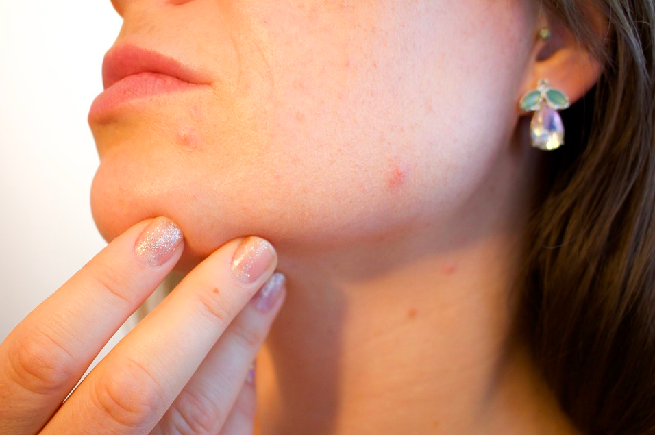 histamine acne puistjes
