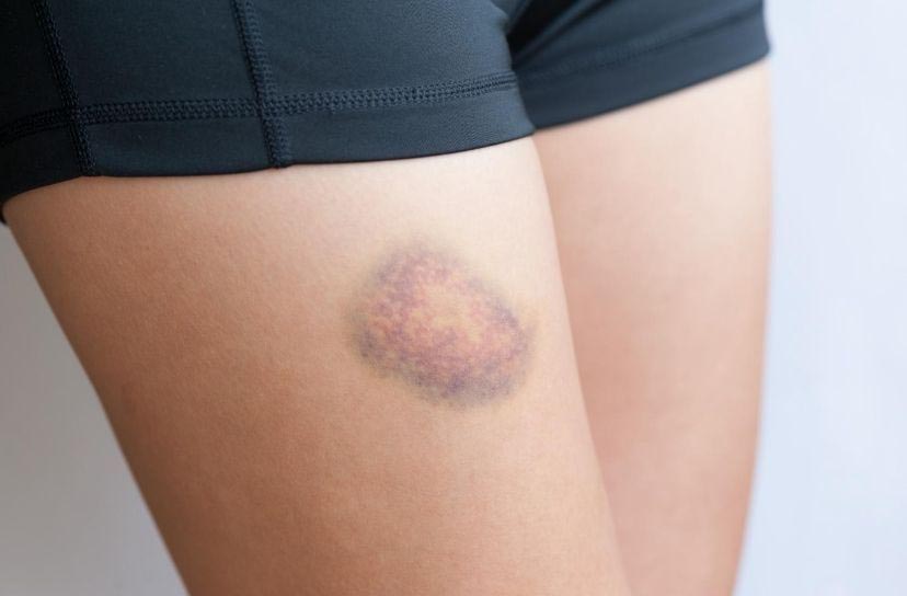Waarom krijg ik snel blauwe plekken en ben ik zo moe?